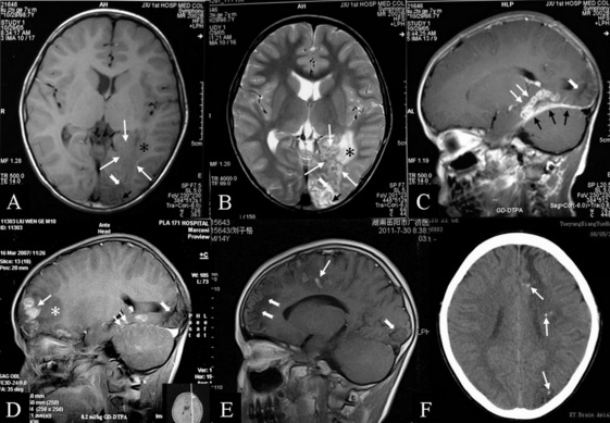 15 Shocking and Horrifying Parasites You Didn’t Know May Be Inside Your